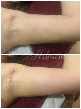エルール トータルビューティ(Aileure total beauty)/術後ケア 二の腕