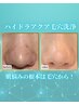 【徹底いちご鼻除去毛穴洗浄コース】ハイドラアクアピール｜水光肌仕上げ