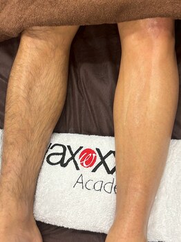 美麗(MIREI)の写真/カミソリ負けやチクチクに悩む男性必見！ワックスと光のセット施術で、清潔感溢れるツルツル肌を叶えます◎