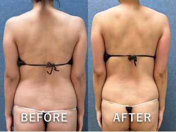 ビーホープ(B.hope)/30代モニター様10回目