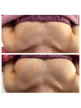 プライベートアトリエ 代官山の写真/◎二の腕・脇・背中のお肉をバストへ!その場で効果を実感◎理想の谷間へ導くエステ体験♪ (40文字)