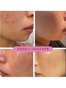 モエラビューティーサロン(Moela beauty salon)/【マーメイドトリートメント】