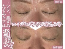 キーオブフェイス(Key of Face)/プラズマハンド×小顔メソッド♪