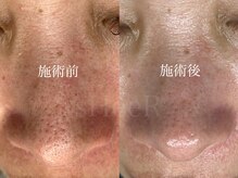 シアー(sHeeR)/毛穴ケア