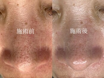 シアー(sHeeR)/毛穴ケア