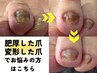 【肥厚爪・変形爪ケア 】¥8800～