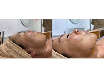 ジュエルビューティー(Jewel Beauty)/フェイスラインUPくすみサヨナラ