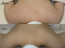 ララ オートクチュール(LALA HAUTOCOUTURE)/たった1回のハーブピーリング