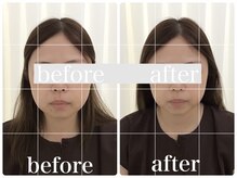 アキュモンド 渋谷院(acumond)/むくみもたつき改善◆1回で変化