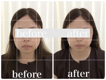 アキュモンド 渋谷院(acumond)/むくみもたつき改善◆1回で変化