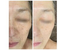 ビューティーワンド ココ(Beauty Wand COCO)の雰囲気（シミ・すくみ・頬のたるみ改善）