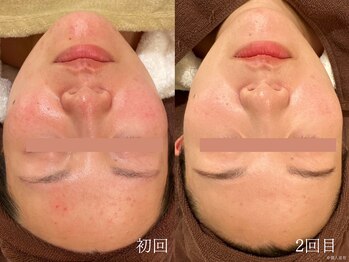 ウォーム(warm)/乾燥/敏感肌/赤み/フェイシャル