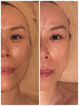 クイーンズ ピュア 恵比寿店(Queen's Pure)の写真/【小顔矯正&巻き肩改善】進化版コルギ【コルグン】+首/肩/肩甲骨 強圧リンパ+デコルテマッサージ90分¥12100