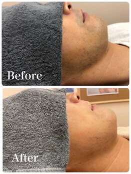 エアリアル 大牟田店/男性人気NO.1ヒゲ脱毛！