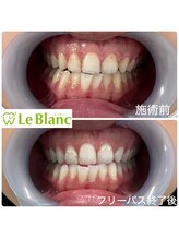 ルブラン 奈良店(Le Blanc)/毎日照射可能！？