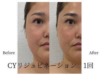 マテオ(Matteo)/CYリジュビネーション