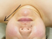 オーパーツ(OOPARTS)/小顔/ブライダル/毛穴/下北沢