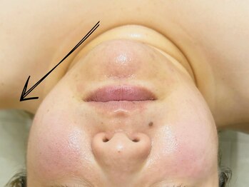 オーパーツ(OOPARTS)/小顔/ブライダル/毛穴/下北沢