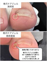 ケアプラス(care plus)/巻爪ケアジェル