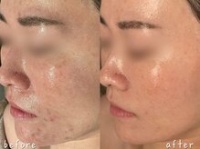 エヌエースキン 武蔵小杉店(Naskin)/ツルっと滑らか肌に！