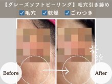 アンジュ(ANGE)/グレーズソフトピーリング症例