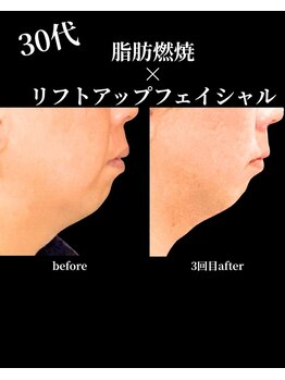 ノーブルノアール(Noble noir)/脂肪燃焼×リフトアップ