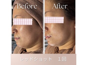 ステラティエ(Stellatier)/シミ/シワ/たるみ/リフトアップ