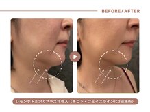 イエス マイサロン(yes My Salon)/レモンボトル施術例