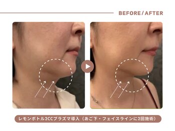 イエス マイサロン(yes My Salon)/レモンボトル施術例