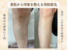 ミスティア(mistia)の雰囲気（産毛と毛穴を同時ケアし透明感のある肌へ◎自己処理から解放♪）