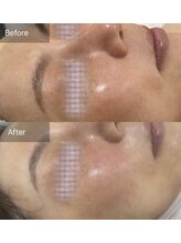 ロエン(Roen)/最高峰ヒト幹細胞原液100%導入