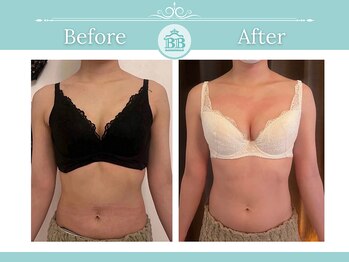美人バスト 柏店/【バストアップ・育乳】症例