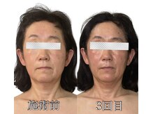 エリクシア 松戸/50代リンパ小顔矯正