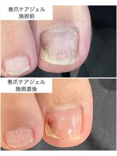 ケアプラス(care plus)/巻爪ケアジェル