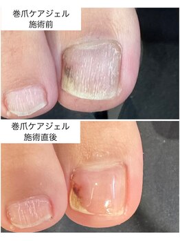 ケアプラス(care plus)/巻爪ケアジェル