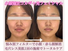 アディス 心斎橋(ADISE)の雰囲気（お悩み、原因に合わせた施術でニキビ、小顔へアプローチ！心斎橋）