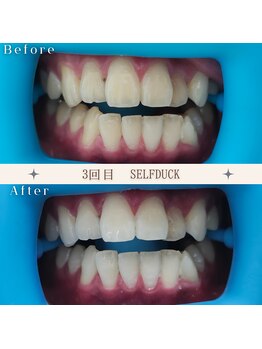 セルフダック 京都長岡京店/◇ホワイトニングの症例写真3
