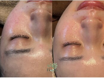 フラーブ(Flourb)/ハーブピーリング|症例写真