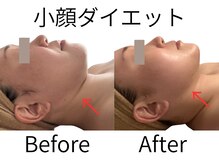 アンドケー(&K)/小顔　１回