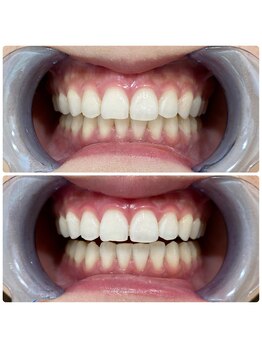 コナホワイトニング 神保町/セルフホワイトニング神保町