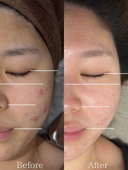 ひじ鍼灸整骨院/小顔鍼Before /After◎