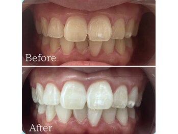 ホワイト 福岡天神店(WHITE)/３ヶ月継続ビフォーアフター