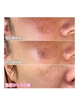 クラルス(clarus)/最新美容機器光フェイシャル