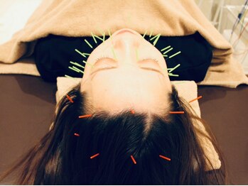 クマノミ美容鍼灸 川口院(KUMANOMI美容鍼灸)/頭皮からもしっかりリフトUP