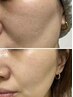 ハーブピーリング【艶水光肌】韓国女優肌になれる初回2g¥13000→¥8900 45分