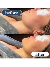 オーロラ(Aurora)/サブスク　フェイシャル　1回目