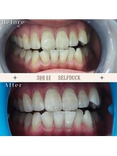 セルフダック 京都長岡京店/◇ホワイトニングの症例写真4