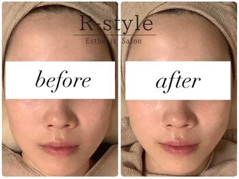 エステサロン アールスタイル(R-style)/ビフォーアフター写真【小顔】