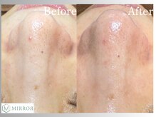 ミラー(MIRROR)/熊本市/毛穴洗浄/西熊本/くすみ