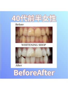 ホワイトニングショップ 西原店/40代前半女性☆BeforeAfter